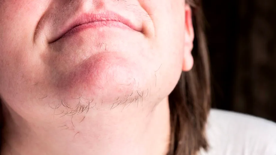 De ce crește părul în barbă la femei. Bolile vinovate pentru părul facial, înainte sau după menopauză