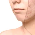 De ce apar petele pigmentare mai repede vara. Remedii naturale care uniformizează tenul