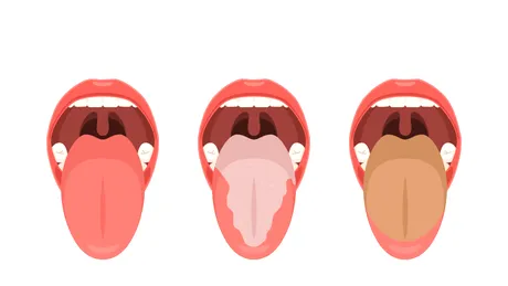 Ce spune limba despre sănătatea ta. Boli pe care le depistezi în oglindă