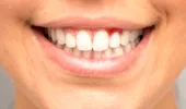 Ce carențe ai dacă îți sângerează gingiile sau îți apar afte
