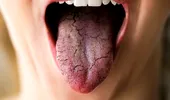 Cum sunt afectați dinții la menopauză. Medic: Primul semn e uscăciunea gurii