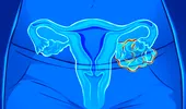 Cancerul ovarian atacă și fetele sub 18 ani! Factori de risc și primele semnale de alarmă