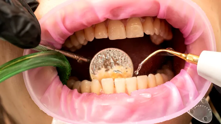 4 mituri despre detartraj. E periculos dacă îl faci prea des?