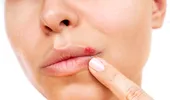 Herpes: Remedii naturale pentru ameliorarea simptomelor și accelerarea vindecării