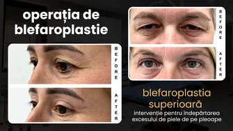 (P) Blefaroplastia superioară: de ce a devenit operația de pleoape cea mai realizată intervenție estetică din lume
