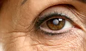 Cataracta: cum se tratează prin operaţie