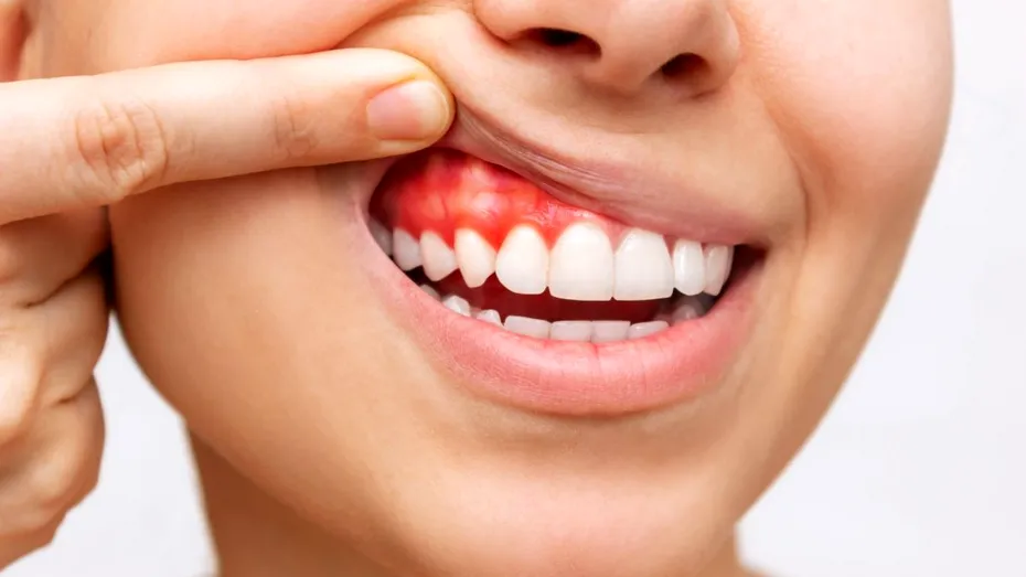 Ce boli grave pot ascunde gingiile vineții, maro, albe sau foarte roșii