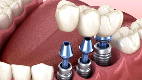 Dinți ficși în 24 de ore: mit sau realitate? Tot ce trebuie să știi dacă te-ai hotărât să-ți pui un implant dentar