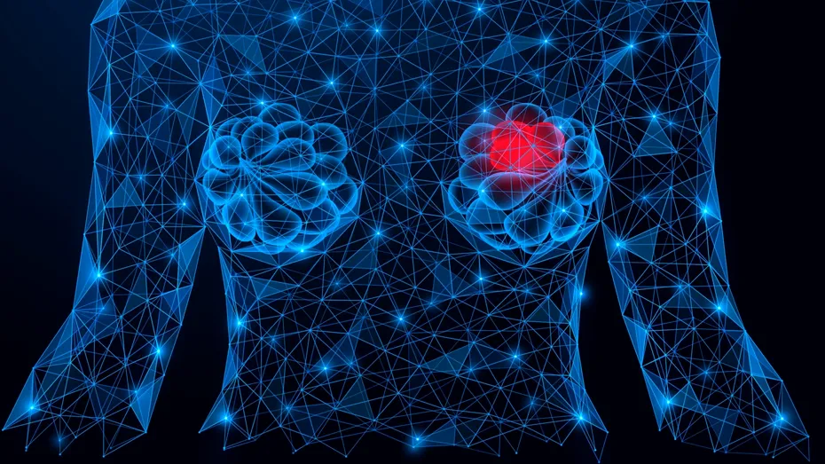 Ce sunt chisturile mamare și de ce sunt femeile cu sâni mici mai predispuse la apariția acestora