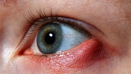 Orjelet: simptome si tratament