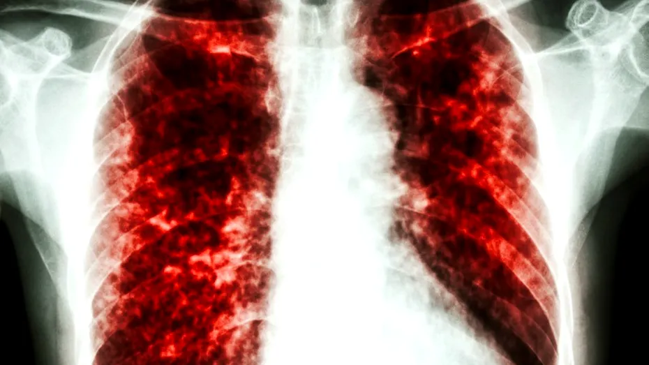 Pneumonia interstiţială la copii: simptome și tratament