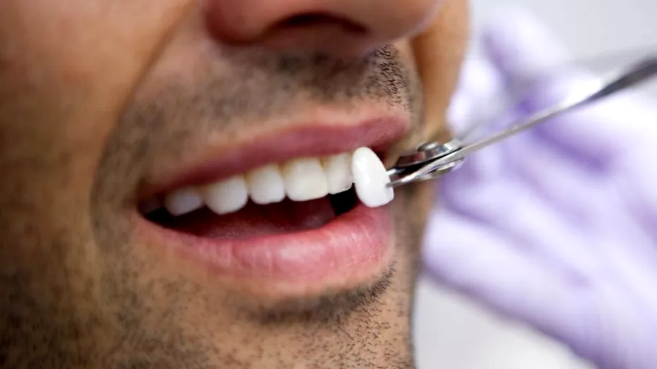 Cât timp rezistă fațetele dentare. 4 semne că trebuie schimbate