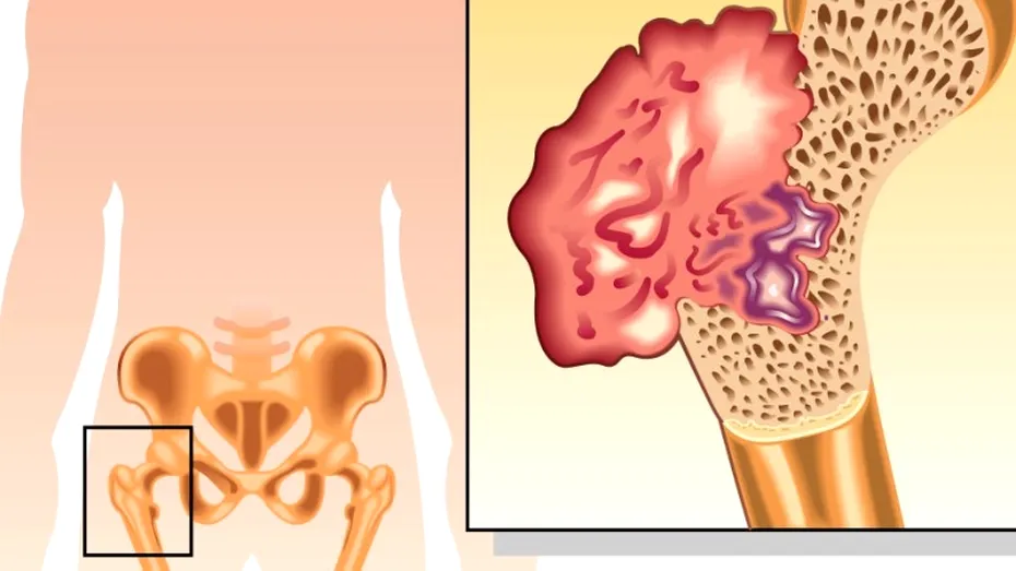 Osteosarcom: cauze, simptome, tratament