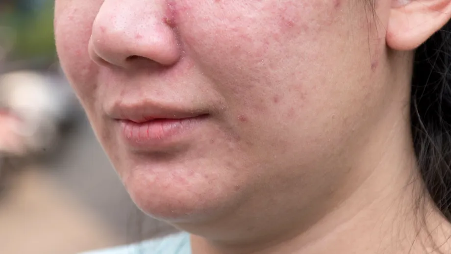 Semnele infertilității se pot vedea pe piele. Iată cum îți dai seama că nu poți face copii