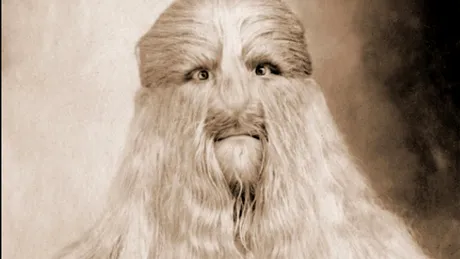 Povestea lui Lionel „Față de Leu”. Boala rară cu care a fost diagnosticat