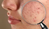 Acnee juvenilă? Află cum îți poți calma pielea cu ingrediente naturale