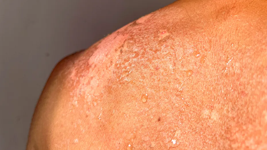 Afecțiunile pielii în anotimpul cald: ce indică și cum le rezolvi