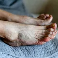Picioarele crăpate îți pot pune viața în pericol! Află ce semn ascund acestea despre sănătatea ta