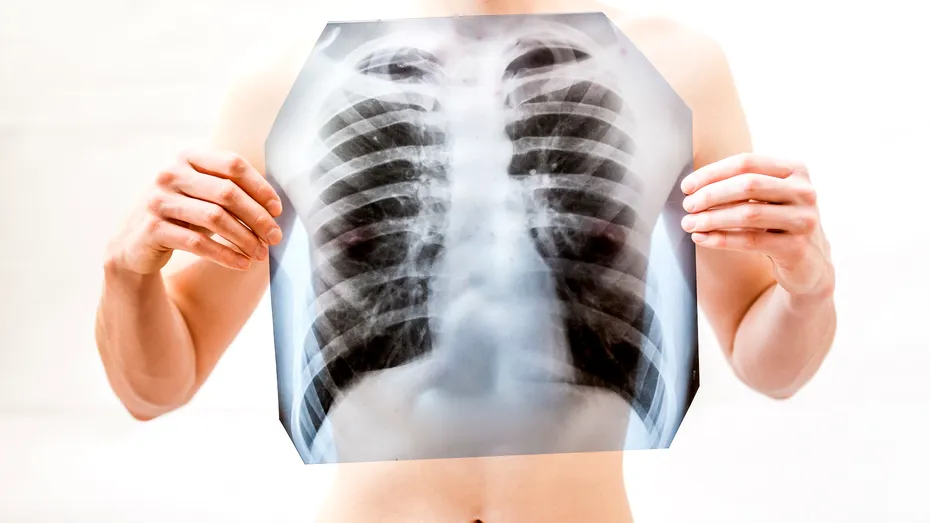 Tuberculoză sau COVID-19? Vezi diferenţele şi asemănările