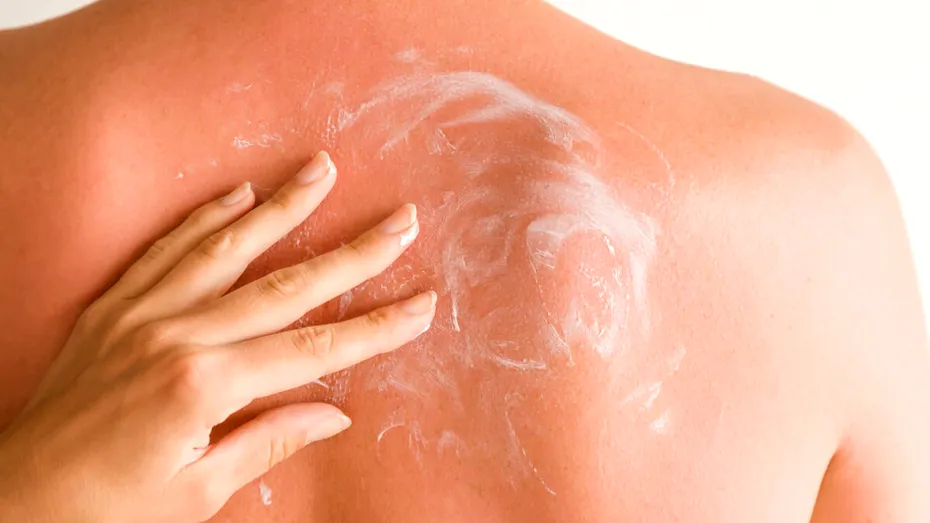 Remediul NATURAL pentru hemoroizi, furuncule și arsuri. Îl poți face acasă. Ce ai nevoie?