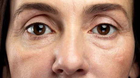 De ce părem obosiți și îmbătrâniți chiar dacă dormim suficient. Pielea din jurul ochilor, cea care ne trădează!
