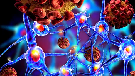 Scleroza multiplă: simptome, tratament