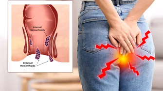 Ce să mănânci pentru a reduce riscul de cancer colorectal. Alimentele recomandate la micul dejun, prânz și cină și ce ar trebui să eviți