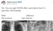 Cum arată plămânii unui bolnav de COVID nevaccinat versus ai unui pacient imunizat