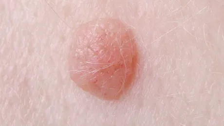 Vegetaţiile veneriene (negii genitali): cauze, simptome, tratament