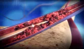 Tromboza venoasă profundă: cauze, diagnostic, tratament