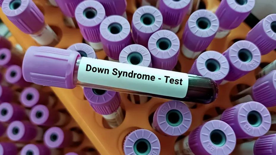 Sindromul Down: cum îl depistăm în sarcină, ce complicații corelate pot apărea în sarcină