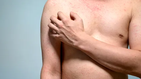 Dermatita atopică nu înseamnă doar piele uscată. Simptomul care poate afecta serios viața de zi cu zi