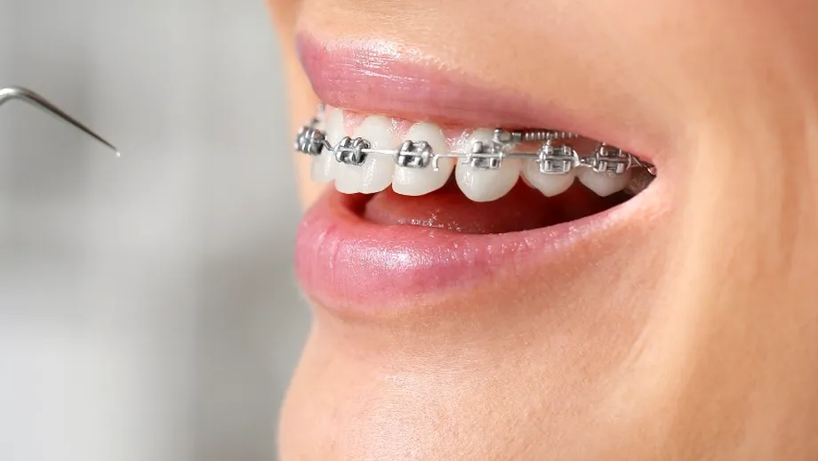 (P) 5 semne clare care indică că ai putea avea nevoie de aparat dentar
