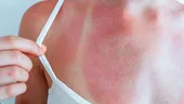 Cum tratezi corect o arsură solară. De ce nu e bine să pui aloe vera pe piele