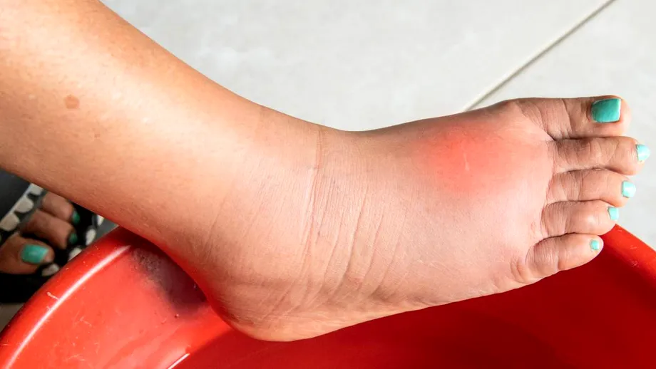 Ceaiul care tratează senzația de picioare grele