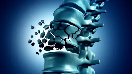 Osteoporoza: simptome, tratament