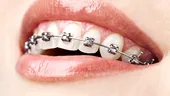 Aparatul dentar este din ce în ce mai popular în rândul persoanelor adulte