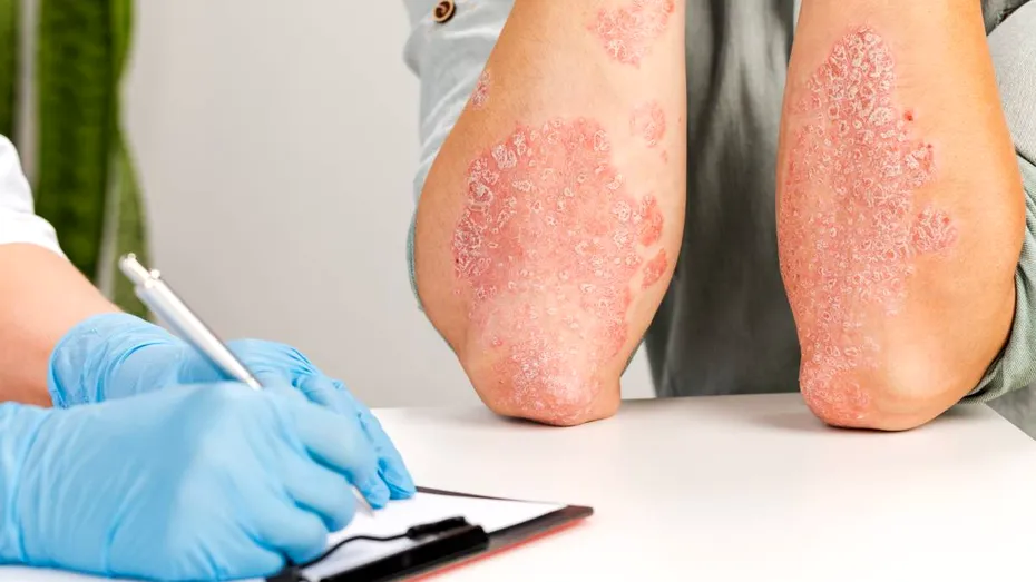 Cele mai întâlnite afecțiuni dermatologice. Bărbații, predispuși la psoriazis și infecții cu transmitere sexuală