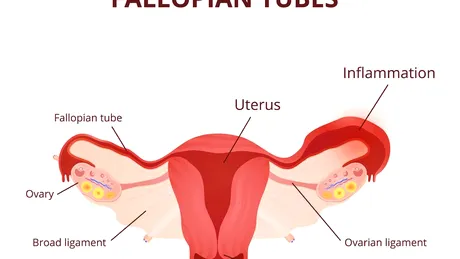 Salpingita: tratament