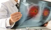De ce foștii fumători rămân vulnerabili la bolile pulmonare. Ce se întâmplă în plămâni după ce renunți la țigări