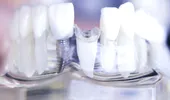 Cum ne poate afecta lipsa unui dinte aspectul feţei