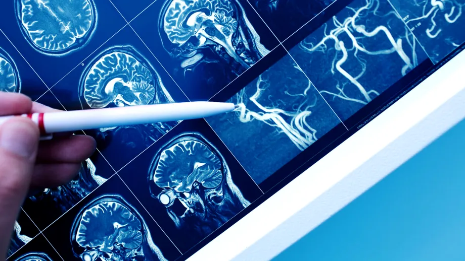 Cum se deformează creierul atunci când muncești prea mult. Descoperirea făcută de cercetători