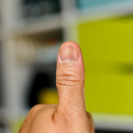 Un bărbat a stârnit îngrijorare în mediul online după ce a postat o poză cu degetul mare având un aspect ciudat
