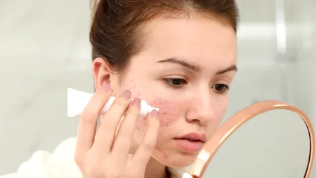 Peroxidul de benzoil face minuni pentru tenul cu acnee. Cum îl folosești ca să scapi de coșurile dureroase