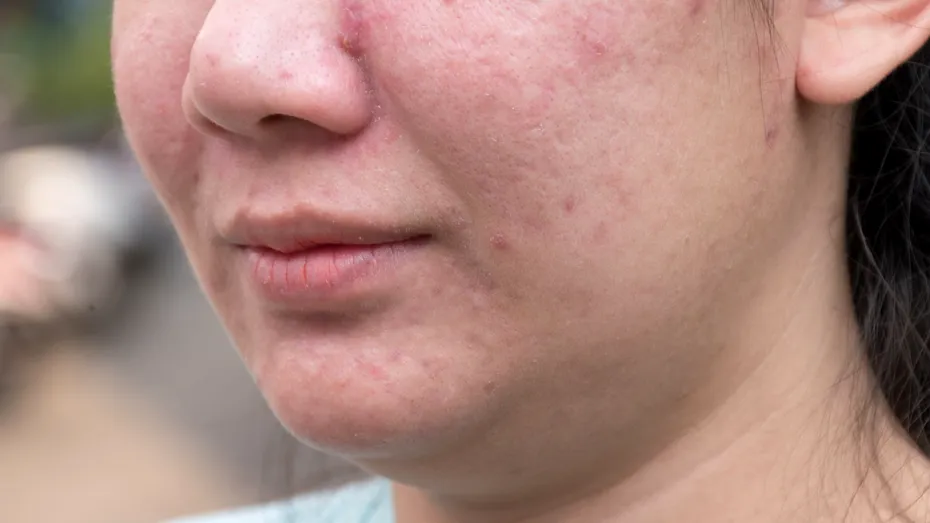 Semnele infertilității se pot vedea pe piele. Iată cum îți dai seama că nu poți face copii