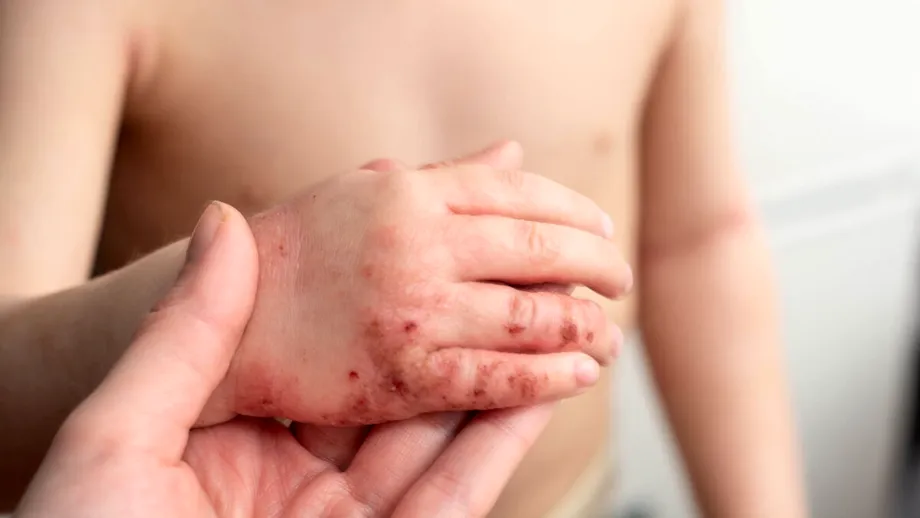 Piodermita: Cum recunoști „infecția ascunsă a pielii” și cum o tratezi rapid