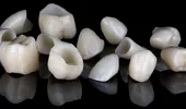 (P) Coroanele dentare explicate: ce trebuie să știi despre fiecare tip
