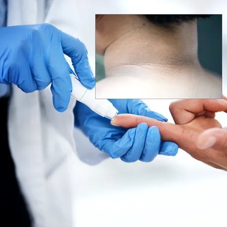 Medicii avertizează: o pată închisă la culoare pe piele poate fi un semn al diabetului de tip 2