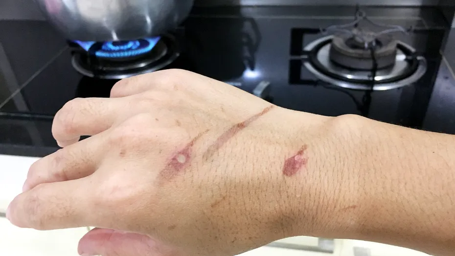 Ce să faci dacă sare ulei încins pe piele. Remedii pentru arsuri cu ulei