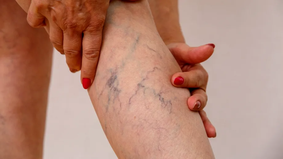 Scapă de varice cu un remediu natural care chiar funcționează